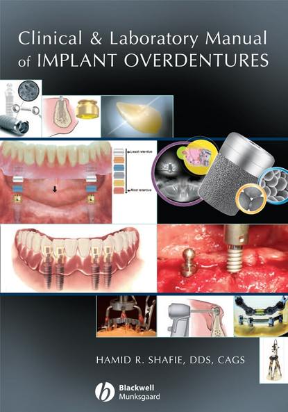 Clinical and Laboratory Manual of Implant Overdentures - Группа авторов