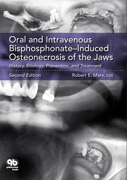 Robert E. Marx - Oral and Intravenous Bisphosphonate–Induced Osteonecrosis of the Jaws