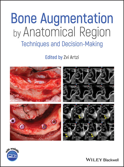 Bone Augmentation by Anatomical Region (Группа авторов). 